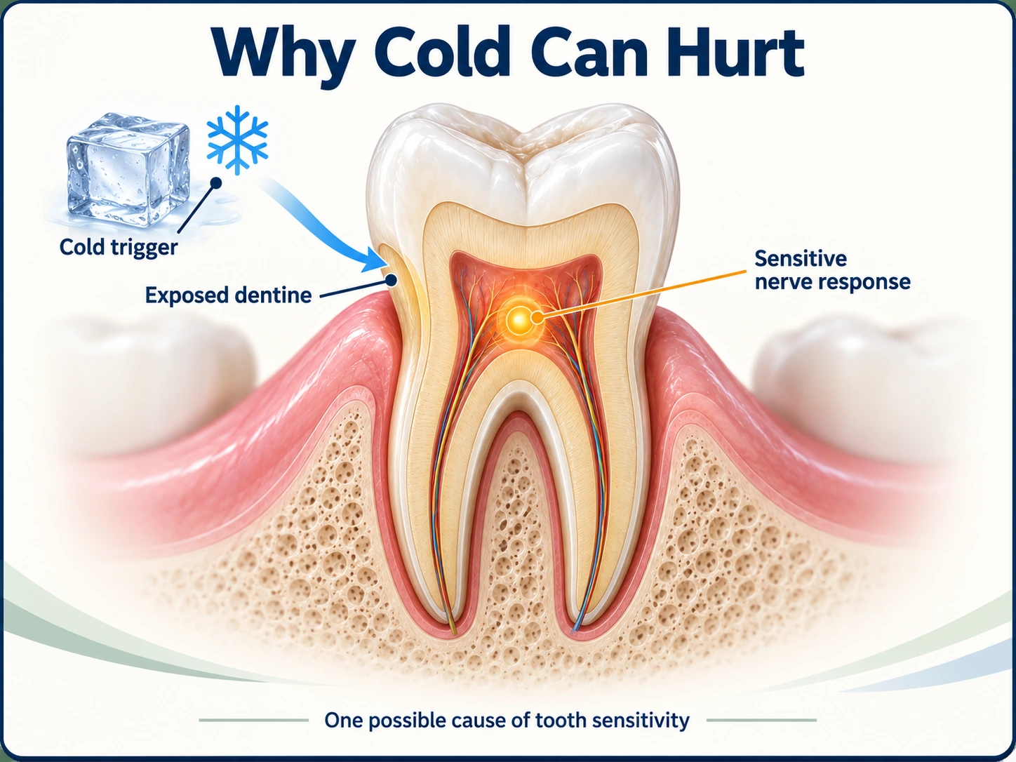 Illustration of a cold trigger at exposed dentine and the nerve response inside a tooth; one possible cause of sensitivity
