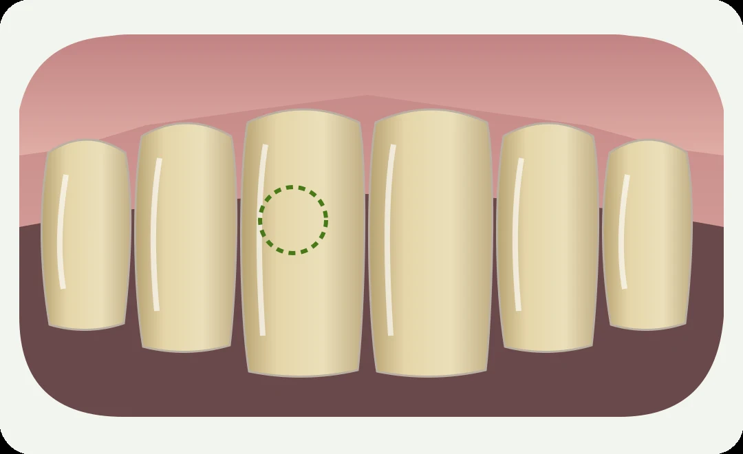 Simplified illustration of discoloured upper front teeth