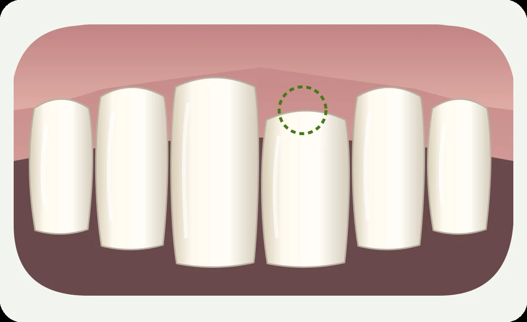 Simplified illustration highlighting uneven gum coverage around a front tooth