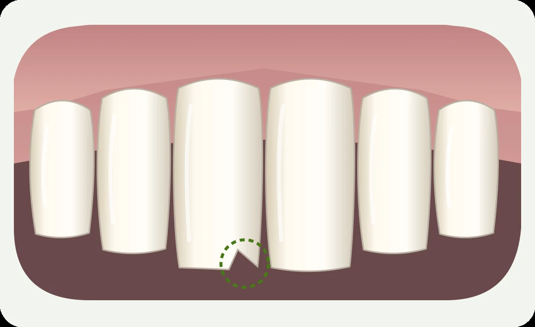 Simplified illustration highlighting a chip at the edge of a front tooth