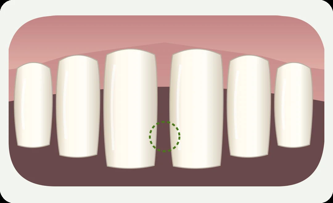 Simplified illustration highlighting a gap between the upper front teeth