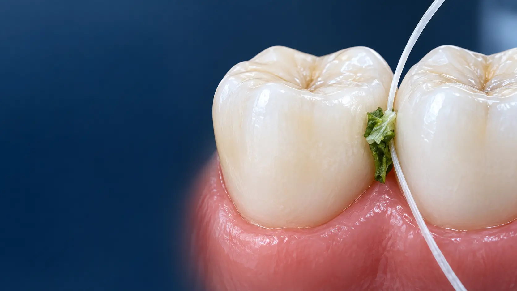 Food caught between two back teeth with floss positioned for gentle cleaning