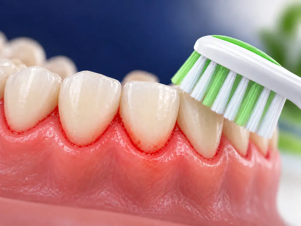 bleeding gums guidance